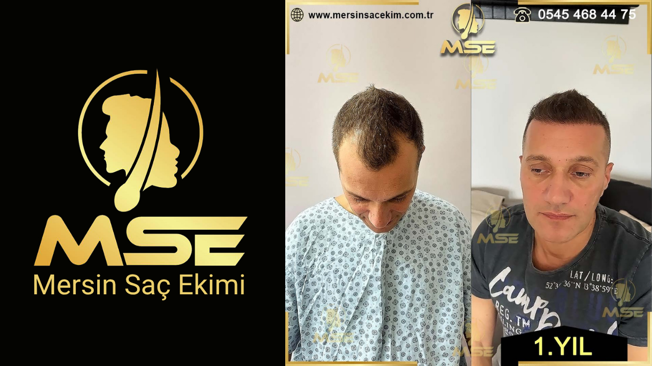 MERSİN SAÇ EKİMİ